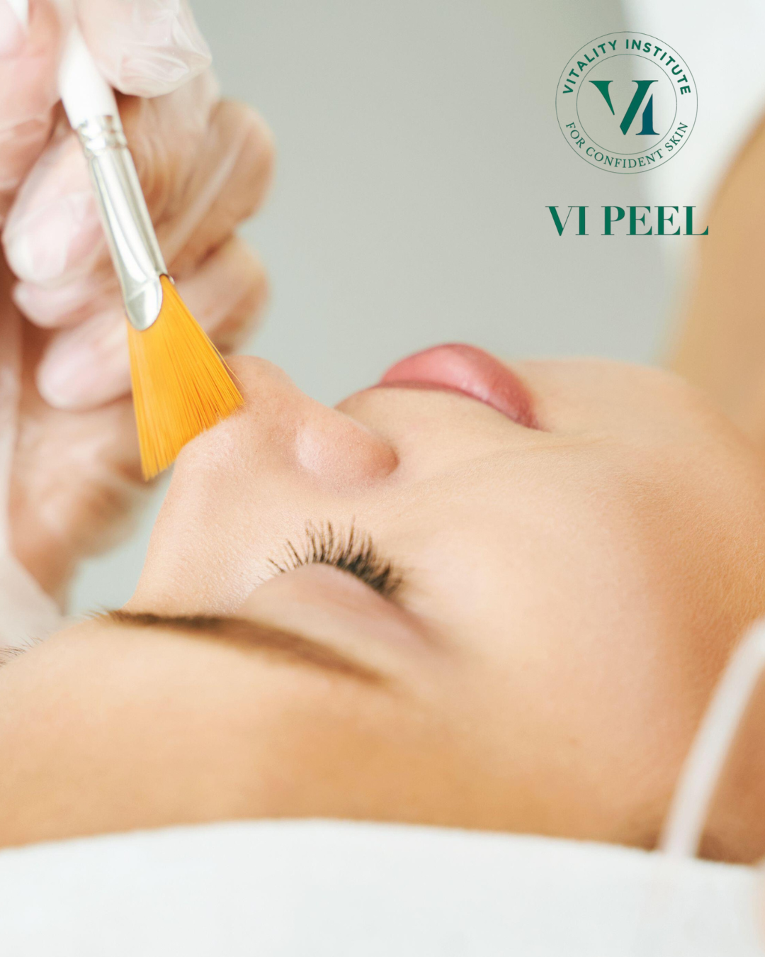 VI Peel Treatment